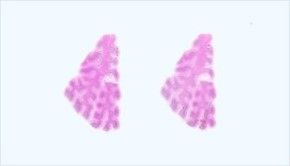 Frozen Tissue Section - Congestive Heart Failure: Heart