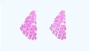 Frozen Tissue Section - Arrhythmia, infarct: Heart Ventricle, left