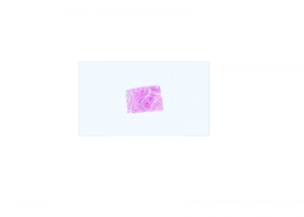 Paraffin Tissue Section – Human Breast Tumor, BRCA Characterized