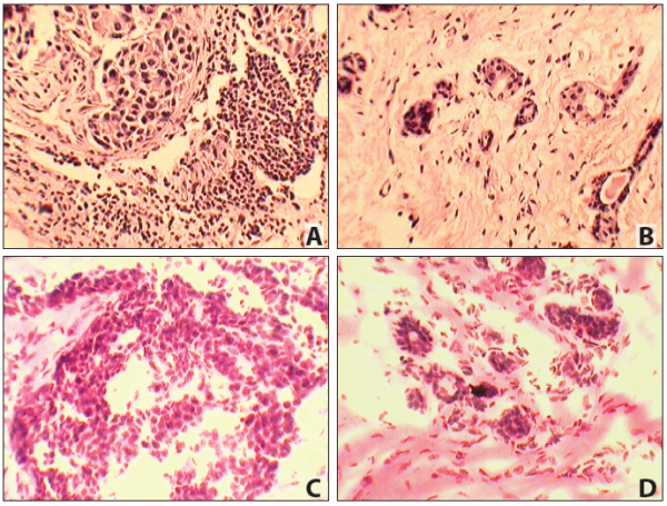 Matched Pair - Frozen Tissue Section - Human Primary and Matched Metastatic Tumor (PM): Lung