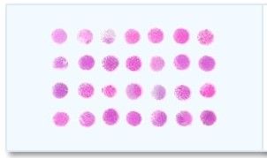 Frozen Tissue Array - 24 Different Prostate Tumors and 4 Corresponding Normal Controls